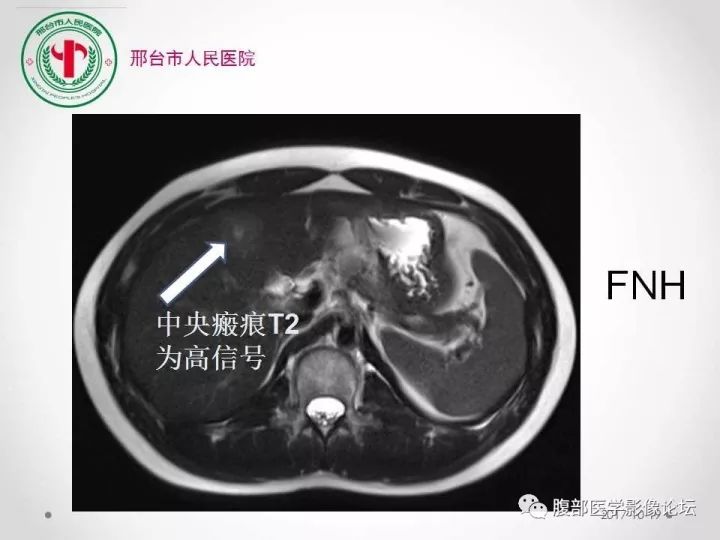 【病例】肝脏原发性神经内分泌肿瘤1例CT影像表现
