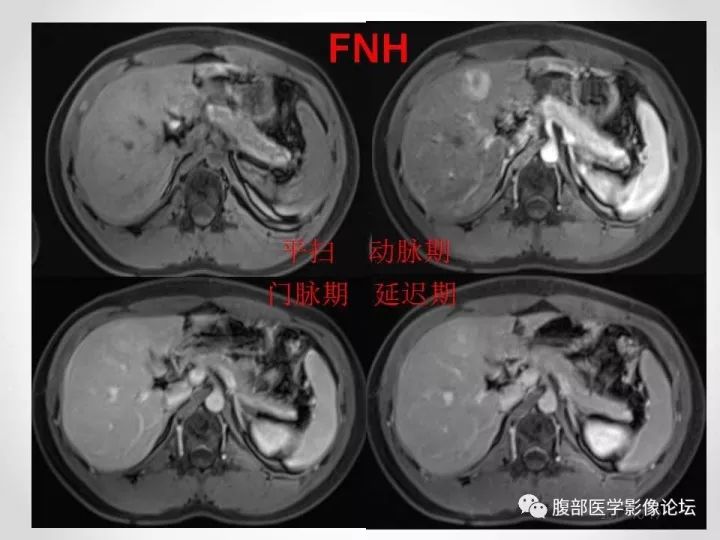 【病例】肝脏原发性神经内分泌肿瘤1例CT影像表现