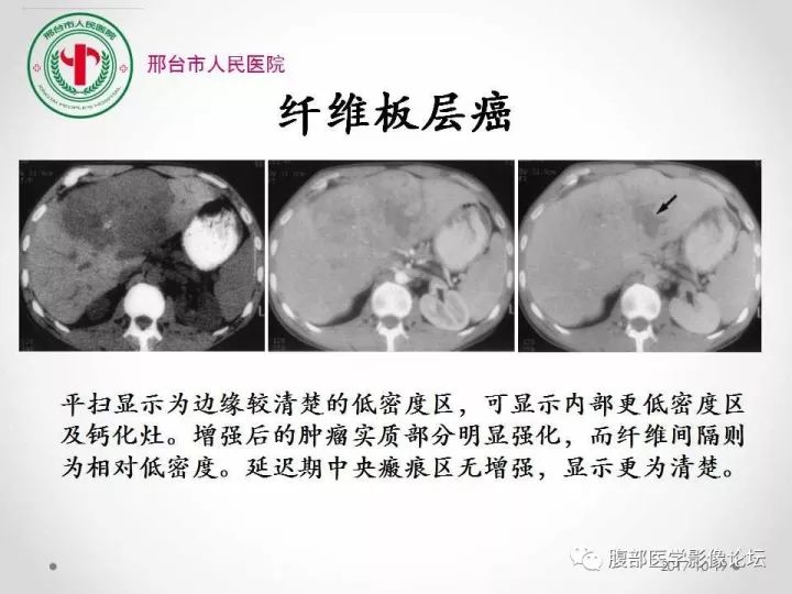 【病例】肝脏原发性神经内分泌肿瘤1例CT影像表现