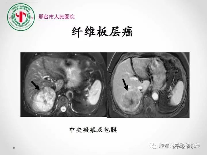 【病例】肝脏原发性神经内分泌肿瘤1例CT影像表现