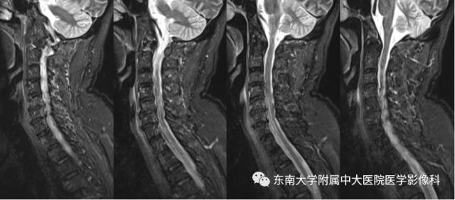 【病例】脊髓前动脉综合征1例MR