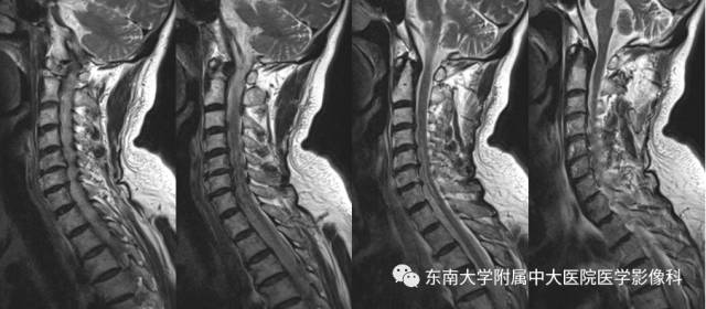 【病例】脊髓前动脉综合征1例MR