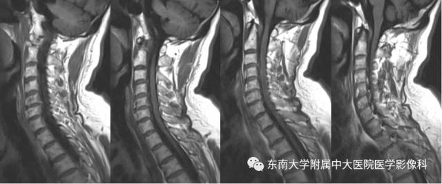 【病例】脊髓前动脉综合征1例MR