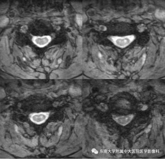 【病例】脊髓前动脉综合征1例MR