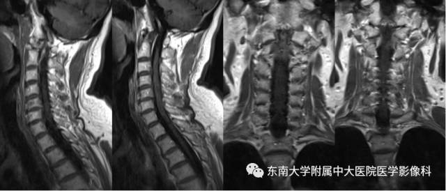 【病例】脊髓前动脉综合征1例MR