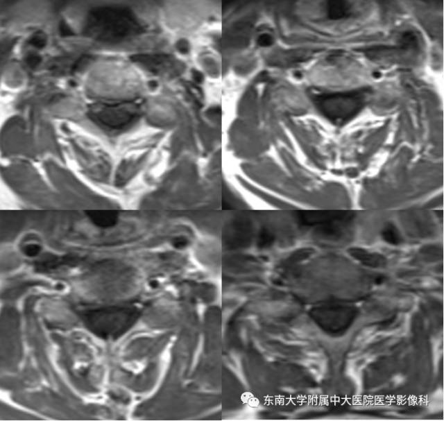 【病例】脊髓前动脉综合征1例MR