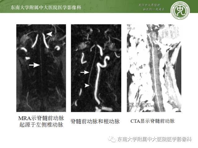 【病例】脊髓前动脉综合征1例MR