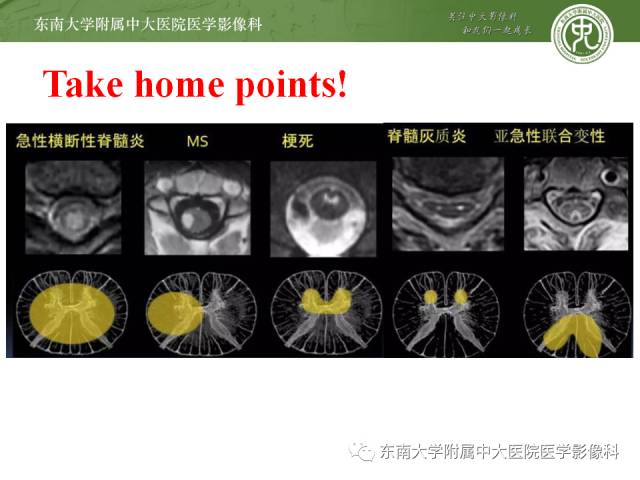 【病例】脊髓前动脉综合征1例MR