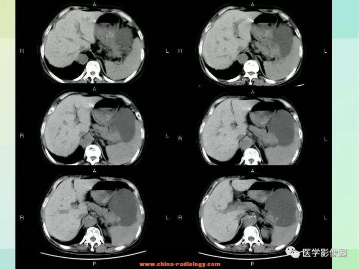【病例】胰尾粘液性囊腺癌1例CT