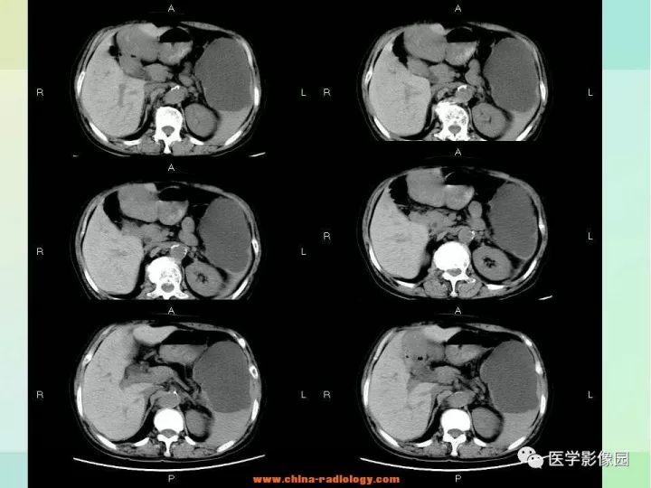 【病例】胰尾粘液性囊腺癌1例CT