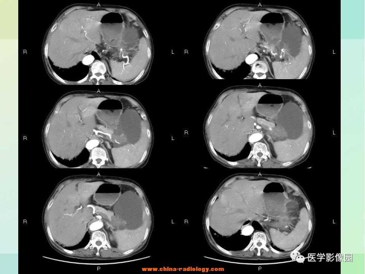 【病例】胰尾粘液性囊腺癌1例CT