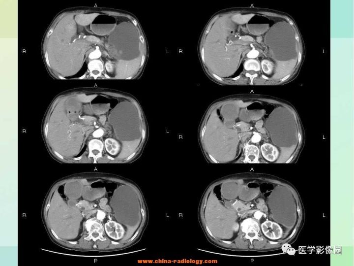 【病例】胰尾粘液性囊腺癌1例CT