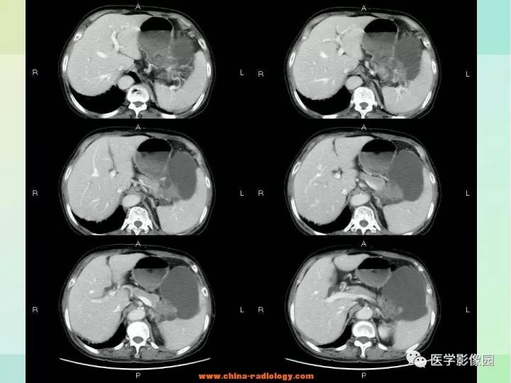 【病例】胰尾粘液性囊腺癌1例CT