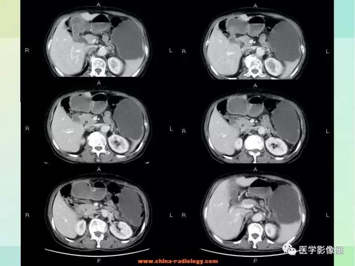 【病例】胰尾粘液性囊腺癌1例CT