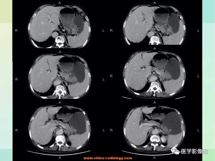 【病例】胰尾粘液性囊腺癌1例CT