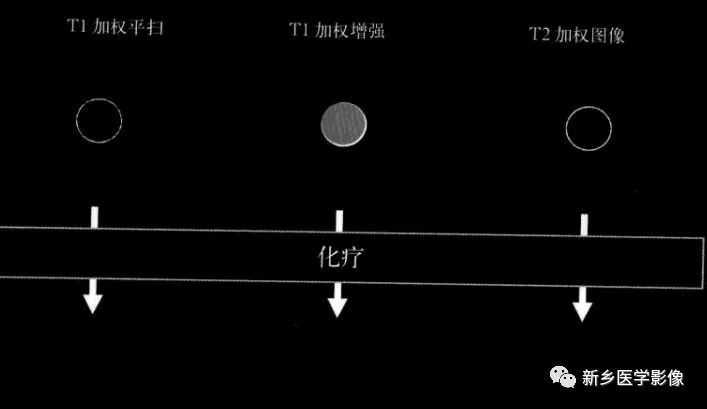 诊断乳腺的病变的主要可靠征象