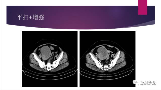 【病例】卵巢囊腺纤维瘤1例CT影像表现