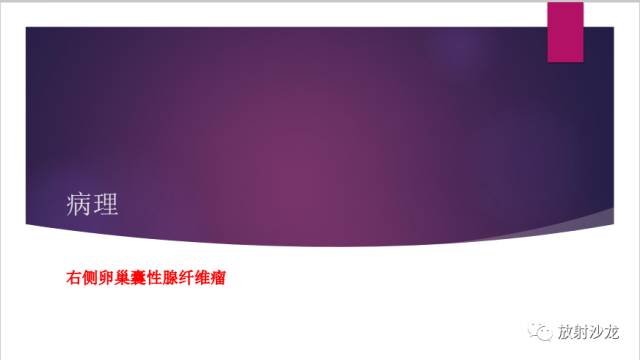 【病例】卵巢囊腺纤维瘤1例CT影像表现