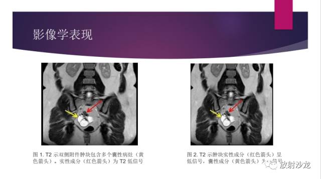 【病例】卵巢囊腺纤维瘤1例CT影像表现