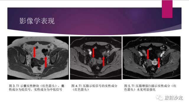 【病例】卵巢囊腺纤维瘤1例CT影像表现