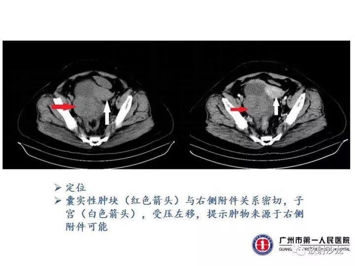 【病例】卵巢囊腺纤维瘤1例CT影像表现