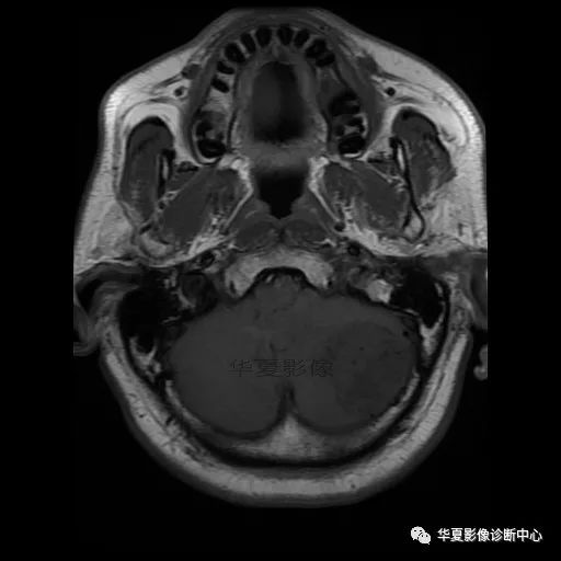 【病例】小脑胶质母细胞瘤1例MR 【病例】小脑胶质母细胞瘤1例MR