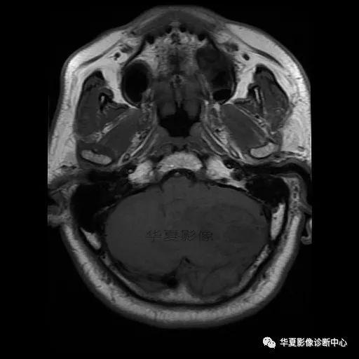 【病例】小脑胶质母细胞瘤1例MR 【病例】小脑胶质母细胞瘤1例MR