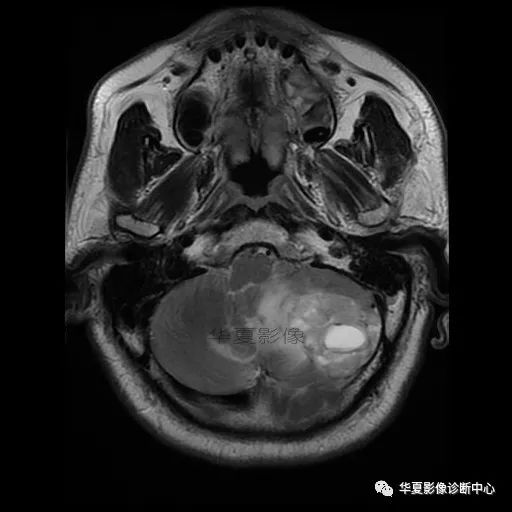 【病例】小脑胶质母细胞瘤1例MR 【病例】小脑胶质母细胞瘤1例MR