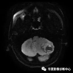 【病例】小脑胶质母细胞瘤1例MR 【病例】小脑胶质母细胞瘤1例MR