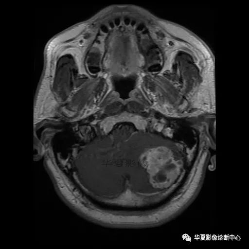【病例】小脑胶质母细胞瘤1例MR 【病例】小脑胶质母细胞瘤1例MR