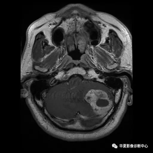 【病例】小脑胶质母细胞瘤1例MR