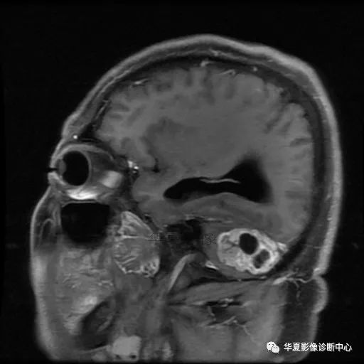 【病例】小脑胶质母细胞瘤1例MR 【病例】小脑胶质母细胞瘤1例MR