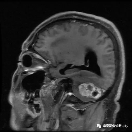 【病例】小脑胶质母细胞瘤1例MR 【病例】小脑胶质母细胞瘤1例MR