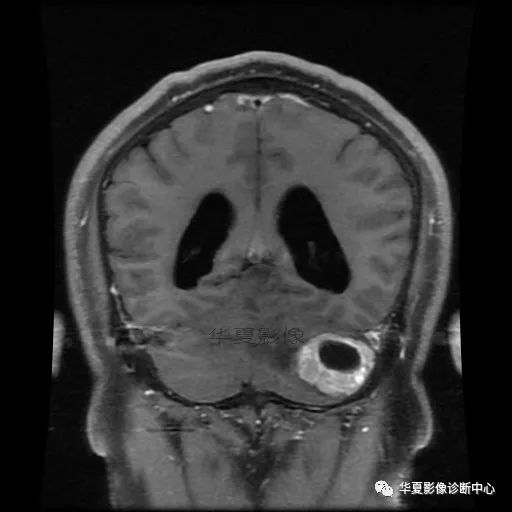 【病例】小脑胶质母细胞瘤1例MR 【病例】小脑胶质母细胞瘤1例MR
