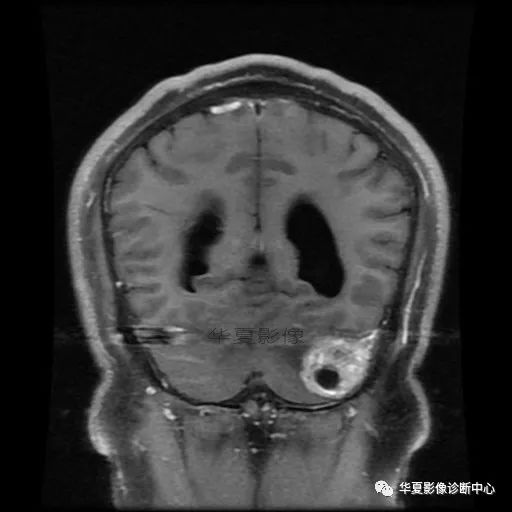 【病例】小脑胶质母细胞瘤1例MR 【病例】小脑胶质母细胞瘤1例MR
