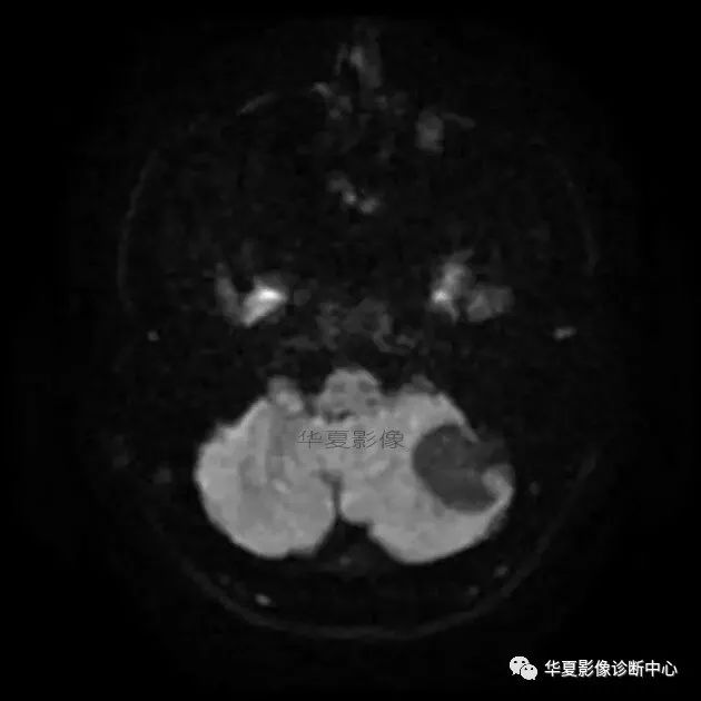 【病例】小脑胶质母细胞瘤1例MR 【病例】小脑胶质母细胞瘤1例MR