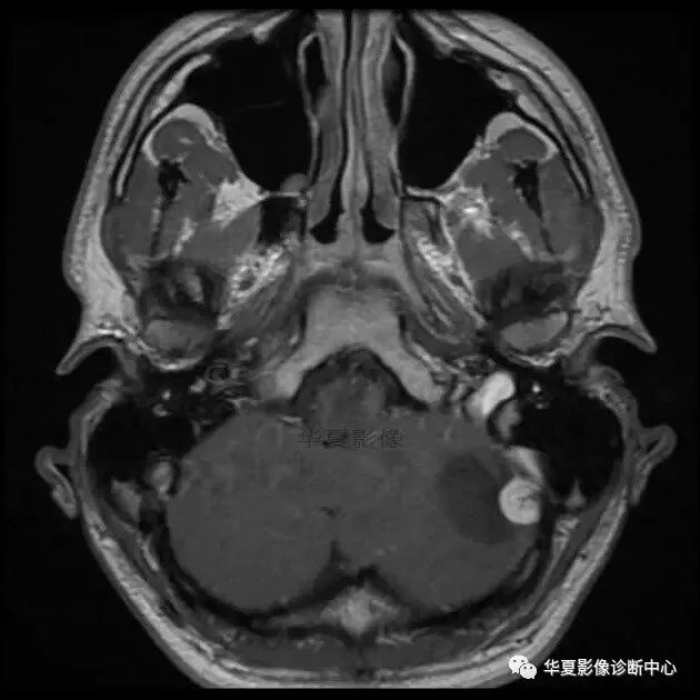 【病例】小脑胶质母细胞瘤1例MR 【病例】小脑胶质母细胞瘤1例MR