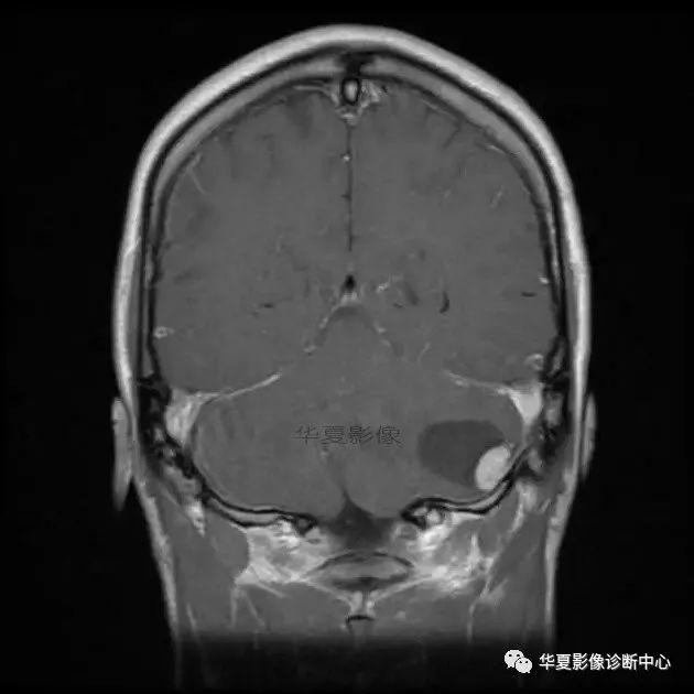 【病例】小脑胶质母细胞瘤1例MR 【病例】小脑胶质母细胞瘤1例MR