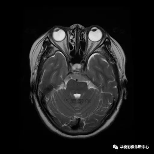 【病例】小脑胶质母细胞瘤1例MR 【病例】小脑胶质母细胞瘤1例MR