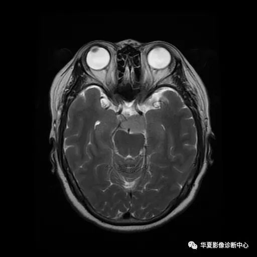 【病例】小脑胶质母细胞瘤1例MR 【病例】小脑胶质母细胞瘤1例MR