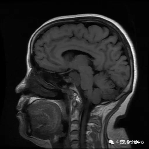 【病例】小脑胶质母细胞瘤1例MR 【病例】小脑胶质母细胞瘤1例MR