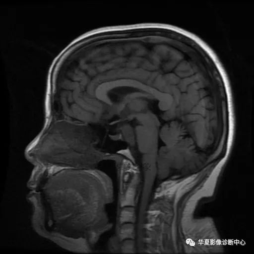 【病例】小脑胶质母细胞瘤1例MR 【病例】小脑胶质母细胞瘤1例MR