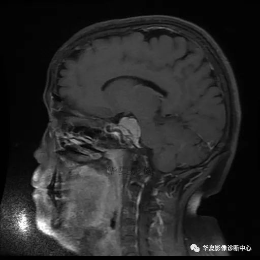 【病例】小脑胶质母细胞瘤1例MR 【病例】小脑胶质母细胞瘤1例MR