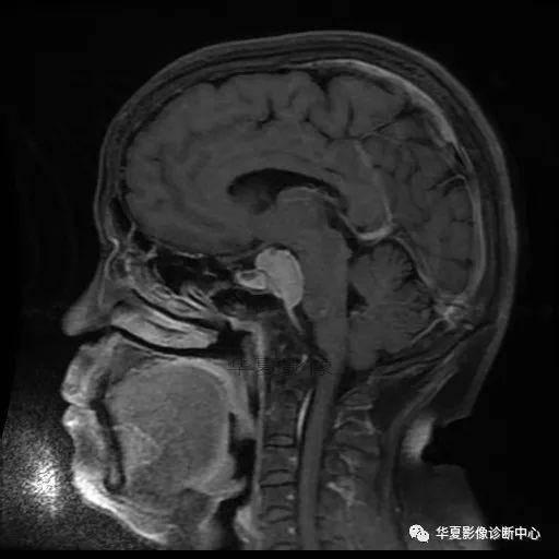 【病例】小脑胶质母细胞瘤1例MR 【病例】小脑胶质母细胞瘤1例MR
