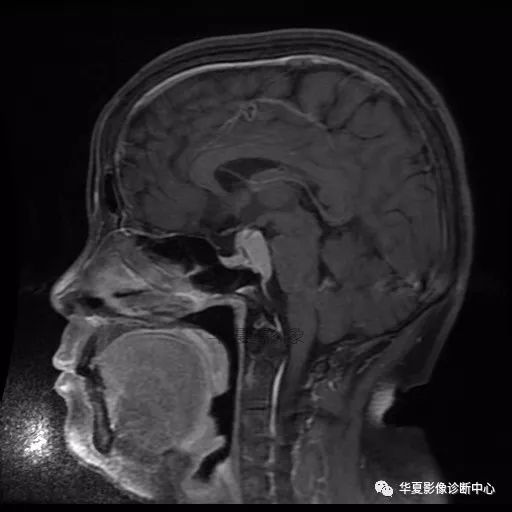 【病例】小脑胶质母细胞瘤1例MR 【病例】小脑胶质母细胞瘤1例MR