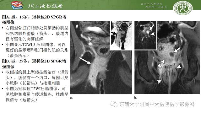 【病例】肛周克罗恩病的MR表现