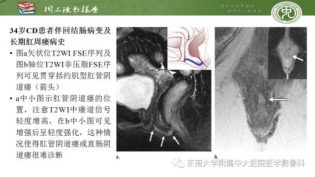 【病例】肛周克罗恩病的MR表现