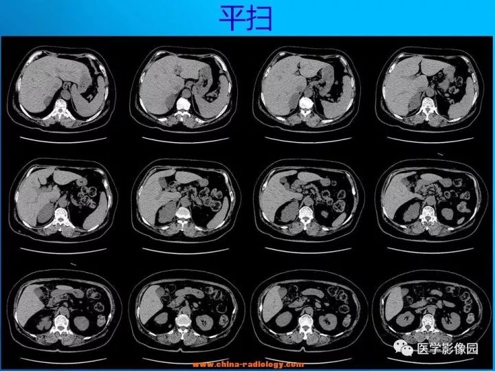 【病例】肾上腺神经节细胞瘤1例CT及MR 【病例】肾上腺神经节细胞瘤1例CT及MR