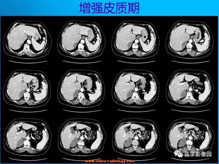 【病例】肾上腺神经节细胞瘤1例CT及MR 【病例】肾上腺神经节细胞瘤1例CT及MR