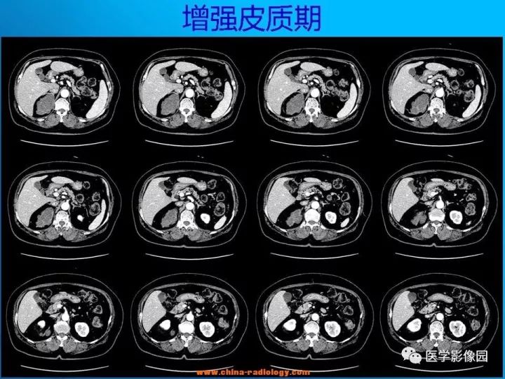 【病例】肾上腺神经节细胞瘤1例CT及MR 【病例】肾上腺神经节细胞瘤1例CT及MR